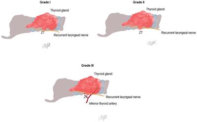 The use of Zuckerkandl's tubercle as an anatomical landmark in identifying recurrent laryngeal nerve and superior parathyroid gland during total thyroidectomy: a prospective single-surgeon study